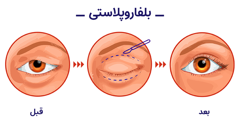 در مورد بلفاروپلاستی